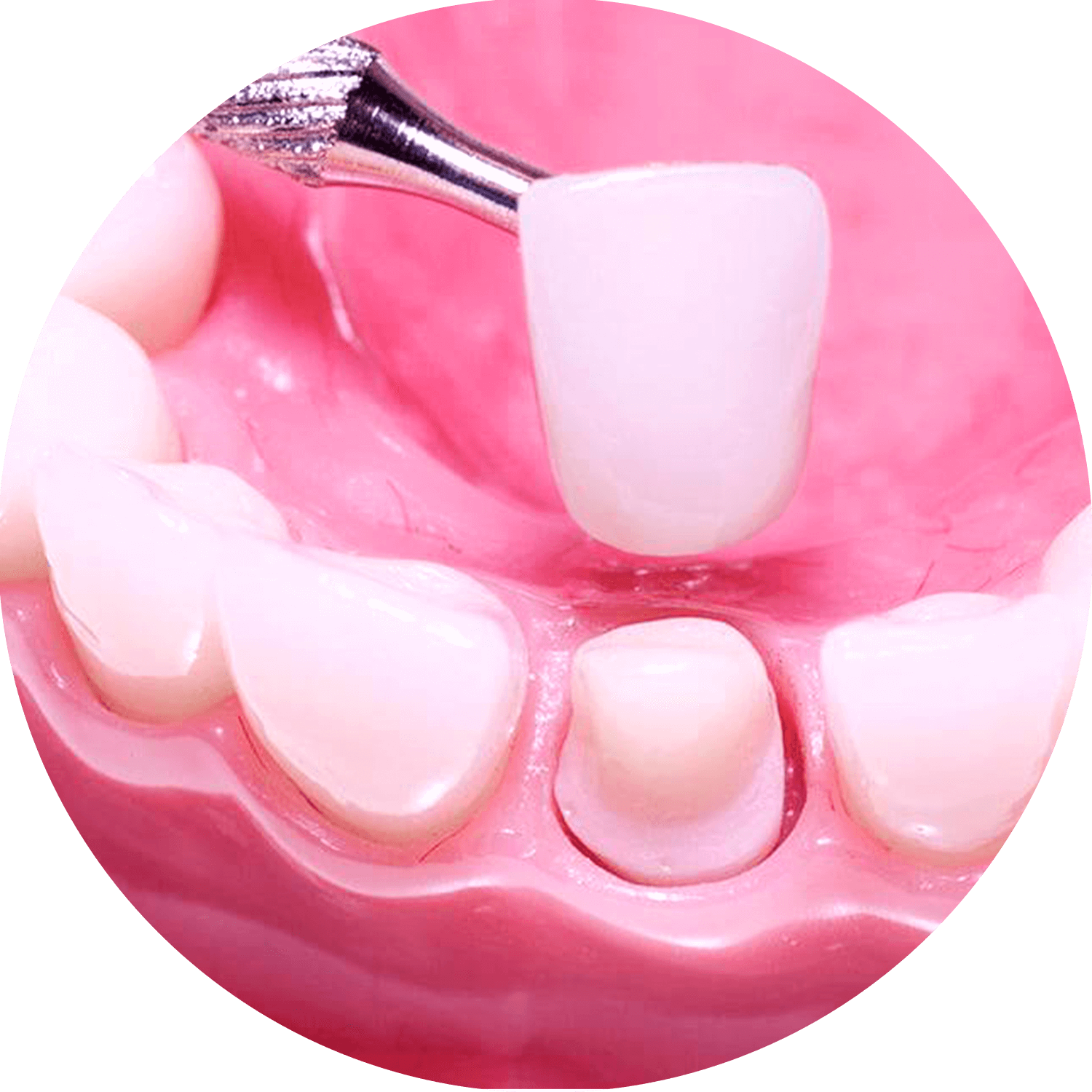 Thẩm mỹ bọc răng sứ