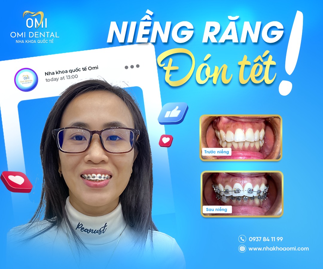 NIỀNG RĂNG BIÊN HOÀ: ĐÁNH GIÁ DỊCH VỤ NIỀNG RĂNG TẠI NHA KHOA OMI – KHÁCH HÀNG NÓI GÌ?