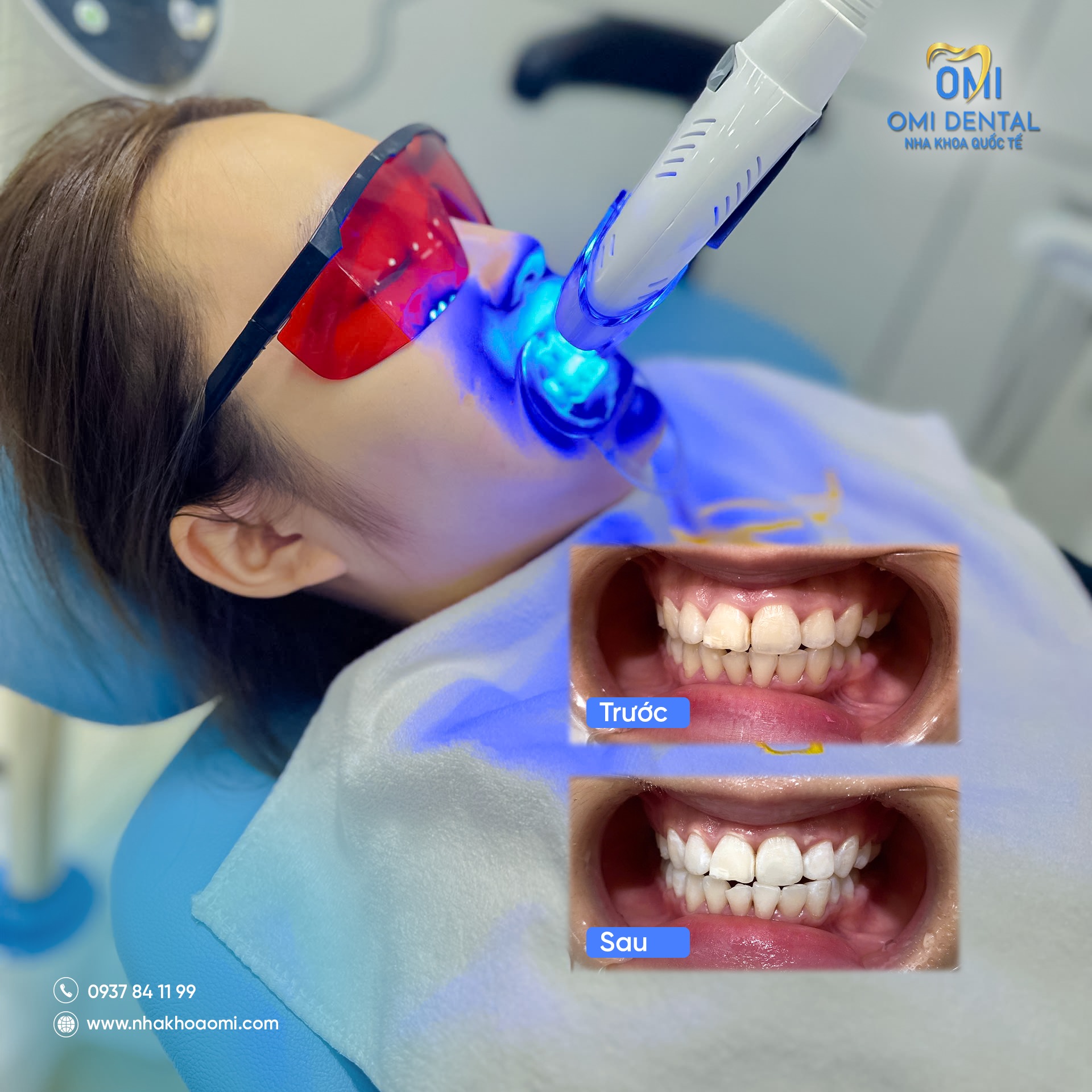 Tẩy trắng răng Biên Hoà - Làm sáng nụ cười