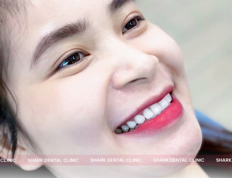 Khách hàng bọc răng sứ tại Nha Khoa Nha khoa Omi Dental