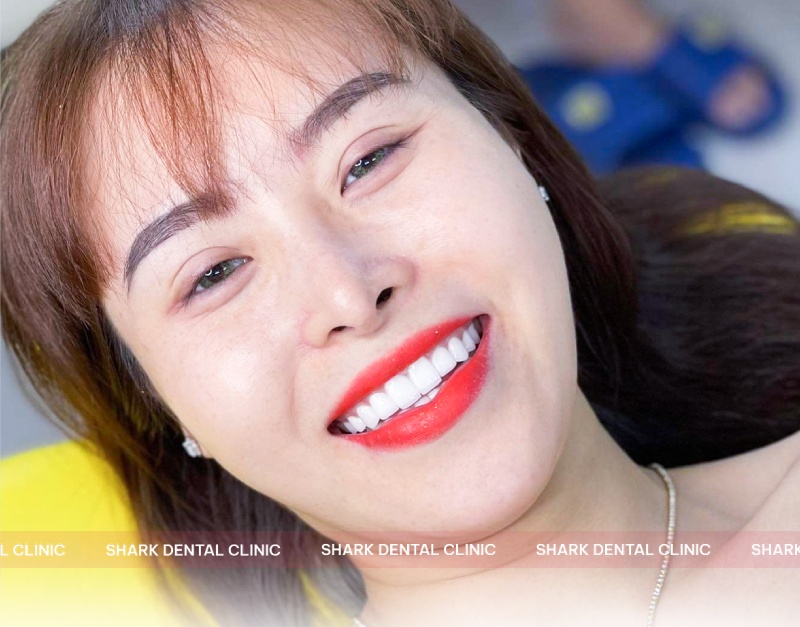 Khách hàng bọc răng sứ tại Nha Khoa Nha khoa Omi Dental