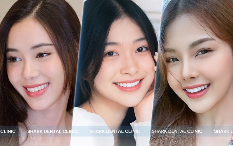 Bọc răng sứ Diamond tại địa chỉ uy tín sẽ sở hữu nụ cười đẹp như ý