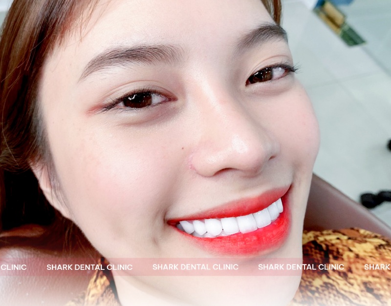 Khách hàng bọc răng sứ tại Nha Khoa Nha khoa Omi Dental