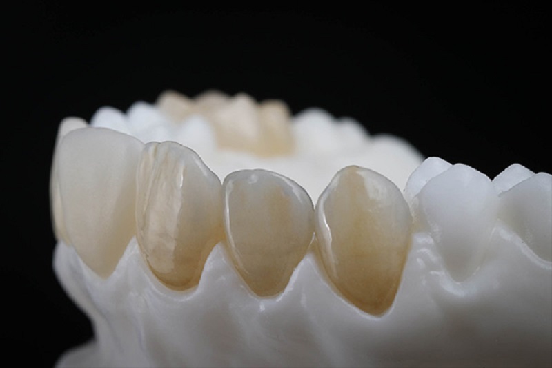 Màu sắc răng Venus khi so sánh với những dòng răng sứ toàn sứ khác sẽ có phần kém hơn