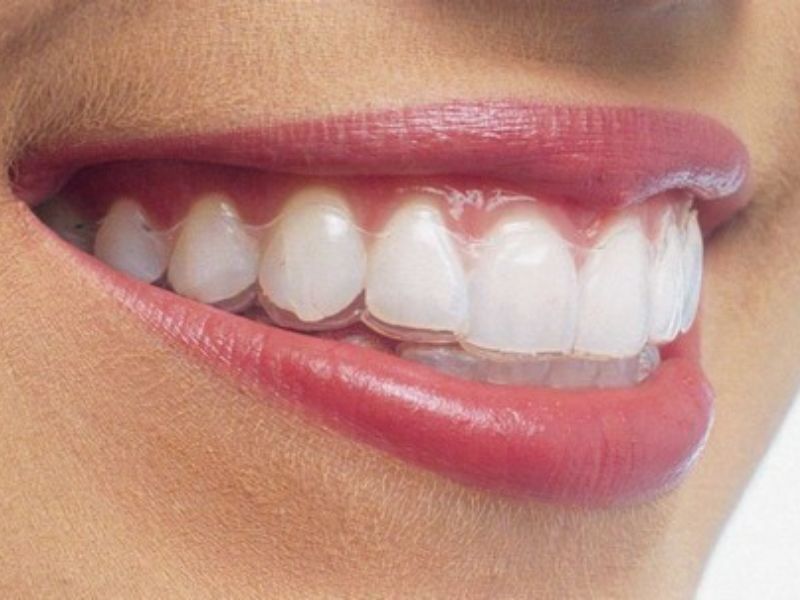 Niềng răng trong suốt sẽ gây ê buốt trong thời gian đầu nhưng bạn có thể chịu đựng được và giảm dần ngay sau đó