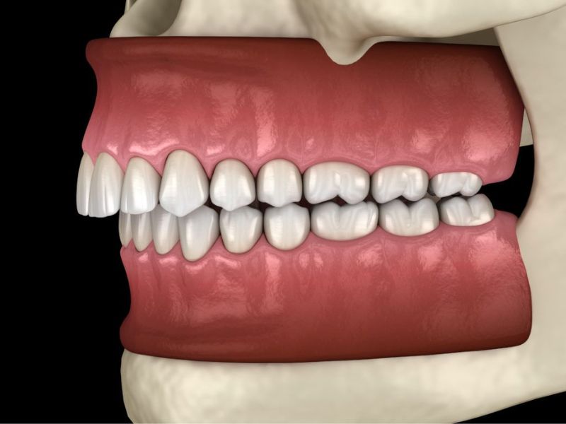 Những trường hợp răng có khớp cắn hở, khớp cắn sâu cần đeo khay niềng để khắc phục