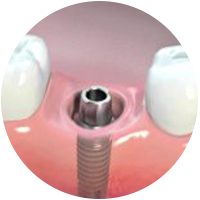 Cấy ghép Implant