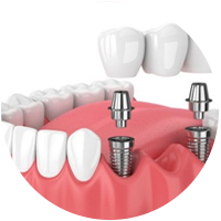 Cấy ghép Implant