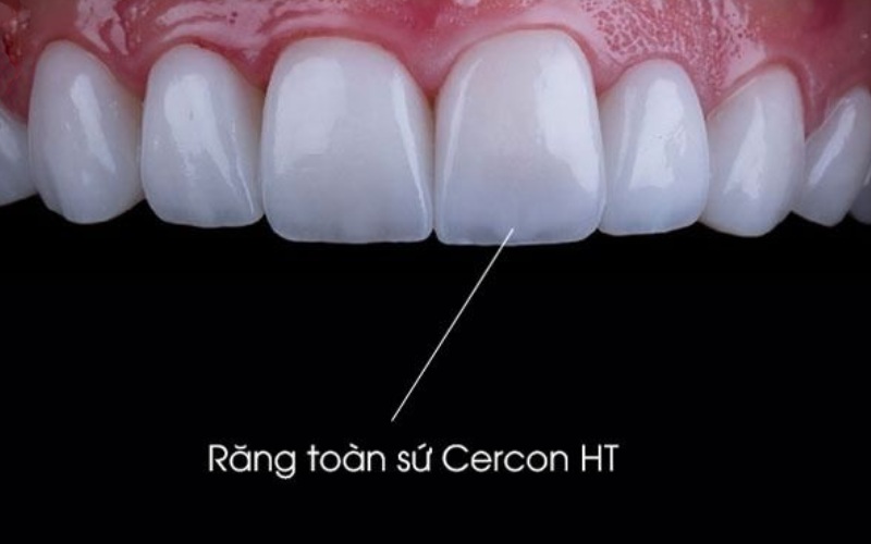 Răng sứ Cercon HT được rất nhiều người lựa chọn