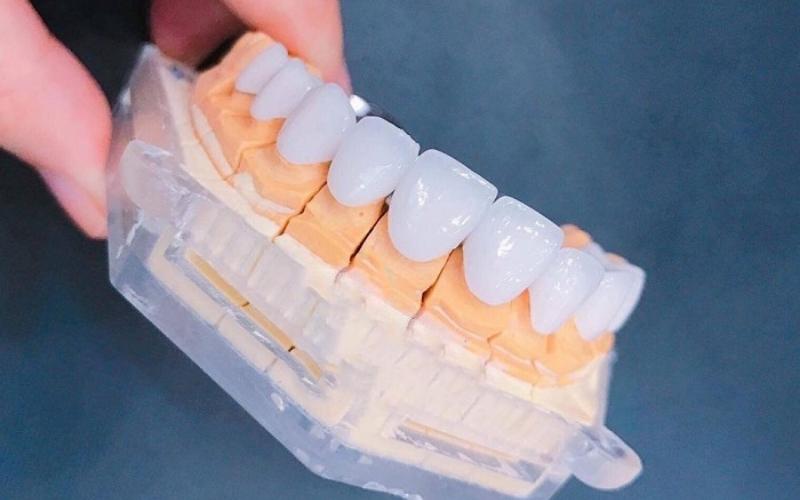 Orodent White Matt Zirconia có độ cứng cao gấp 7-9 lần so với răng tự nhiên của con người