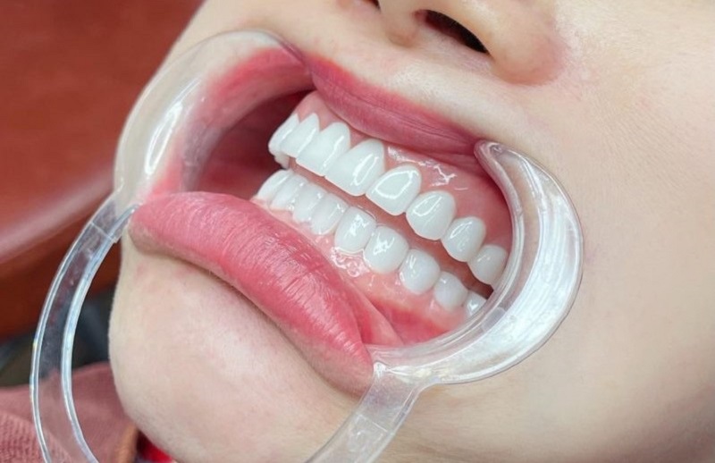 Orodent Bleach Innovation là sự lựa chọn hàng đầu của nhiều khách hàng