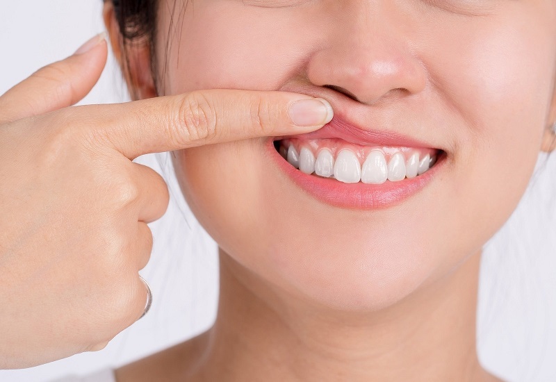 Hiệu ứng sáng lấp lánh ở Orodent chính là ưu điểm giúp dòng răng sứ này trở nên khác biệt so với các dòng răng sứ khác hiện có trên thị trường