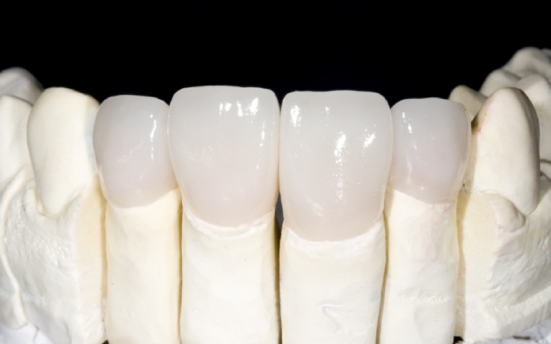 Răng sứ Zirconia được làm hoàn toàn từ sứ Zirconia nguyên chất