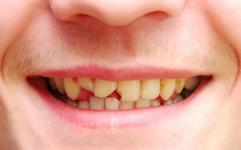 Trường hợp nên bọc răng sứ Zirconia
