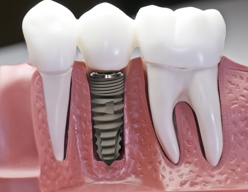 Trụ Implant Dentium có khả năng nhanh chóng tích hợp với xương hàm