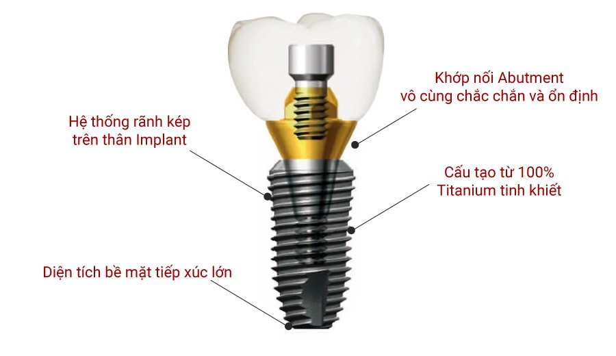 Trụ Implant Dentium Hàn Quốc là sự liên kết giữa trụ Implant và khớp nối Abutment
