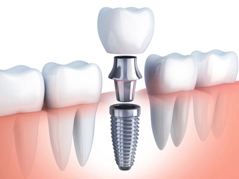  Trụ răng Implant Nobel chỉ thích hợp áp dụng cho một số đối tượng nhất định