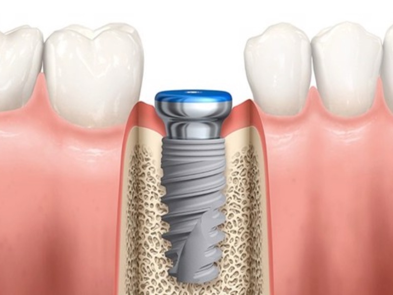 Trụ răng Implant Nobel được sản xuất từ vật liệu nha khoa bền chắc Titanium 