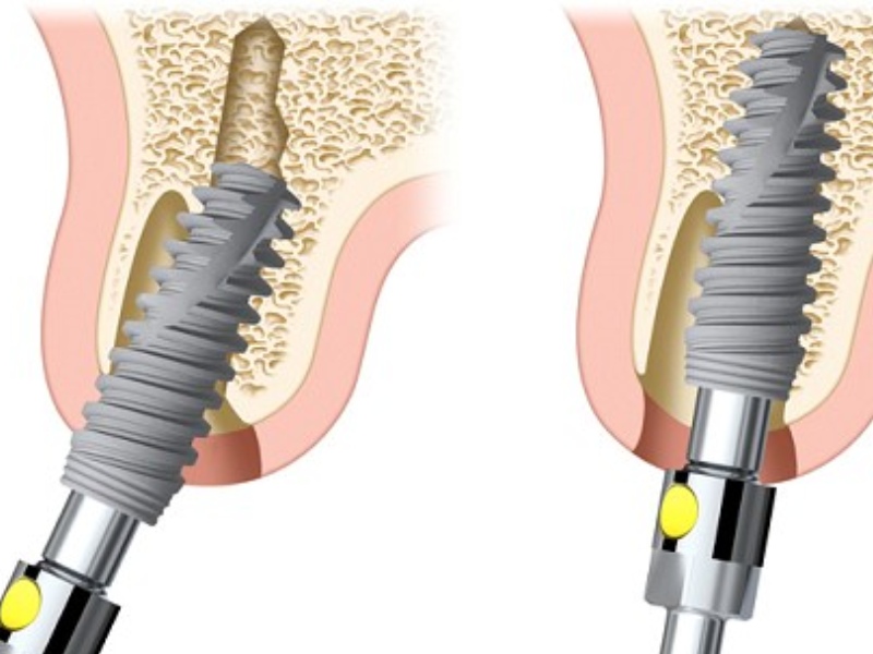 Trụ răng Implant Nobel đã có mặt trên thị trường thẩm mỹ nha khoa từ lâu đời 