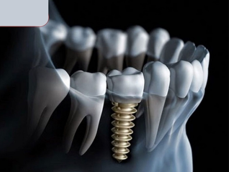 Trụ răng Implant Osstem không được đánh giá cao bằng các trụ Implant sản xuất tại Châu Âu về khả năng tích hợp xương