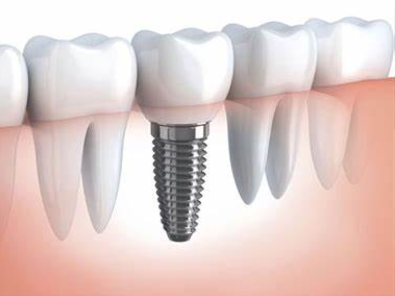 Trụ Implant Osstem của Hàn Quốc được hầu hết các chuyên gia đầu ngành trong lĩnh vực đánh giá cao