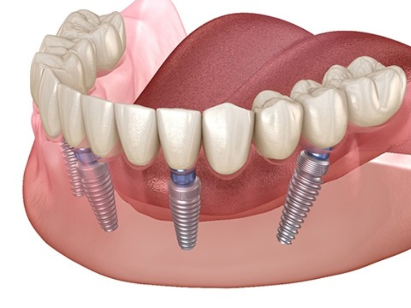 Trụ răng Implant Osstem là vật liệu nha khoa nổi tiếng và rất được ưa chuộng trong lĩnh vực thẩm mỹ