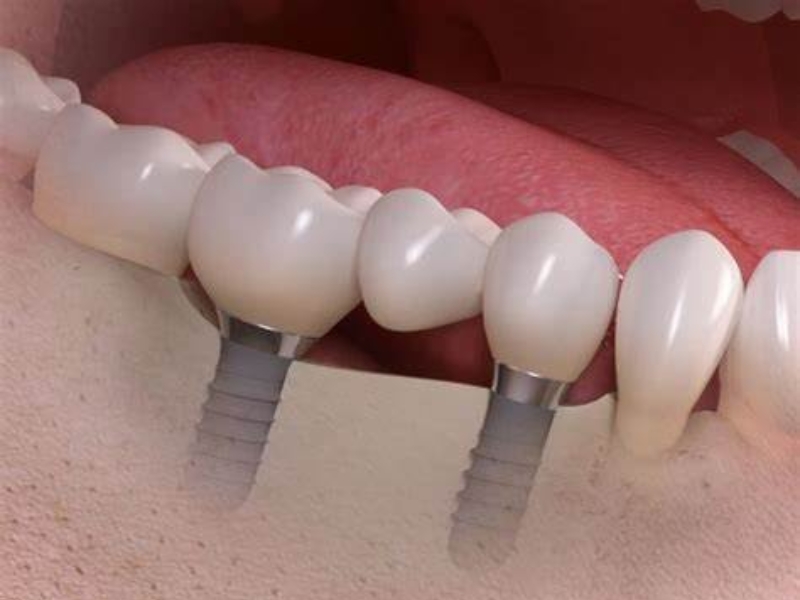 Trụ Implant Straumann SLA có cấu tạo đơn giản