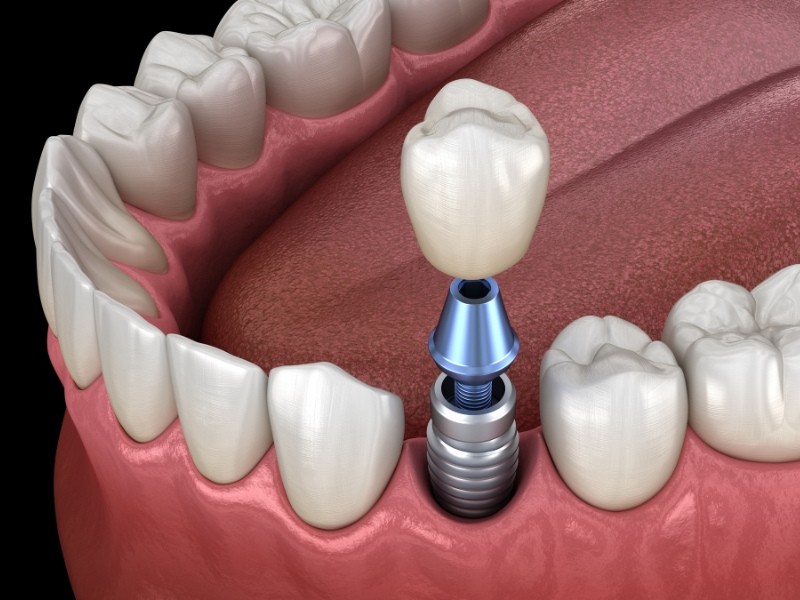 Trụ răng cao cấp Implant Straumann được sản xuất bởi tập đoàn nha khoa Thuỵ Sĩ