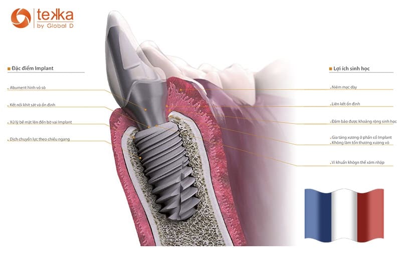 Trụ Implant Tekka của Pháp có tốt hay không?