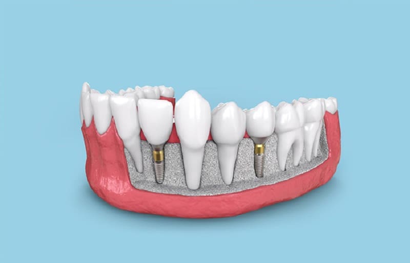 tru implant tekka
